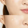 acne-pimple-master-patch-cosrx-official-5_720x